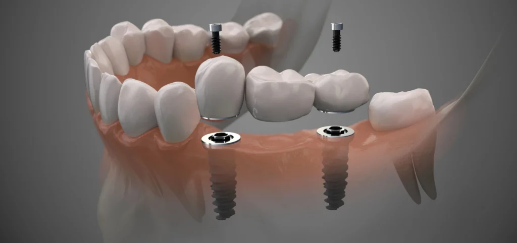 Couronnes et bridges sur implants, dentiste Toulouse 31000