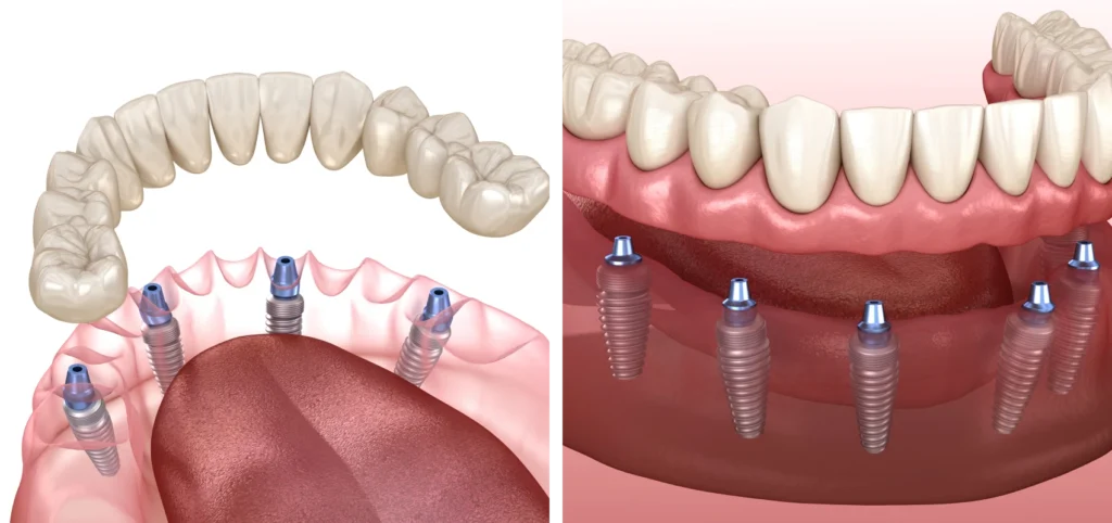 Prothèse amovible sur implants dentiste Toulouse 31000