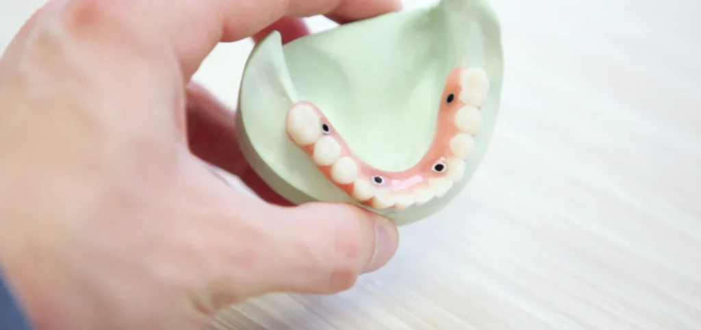 Implant complet dentiste Toulouse 31000