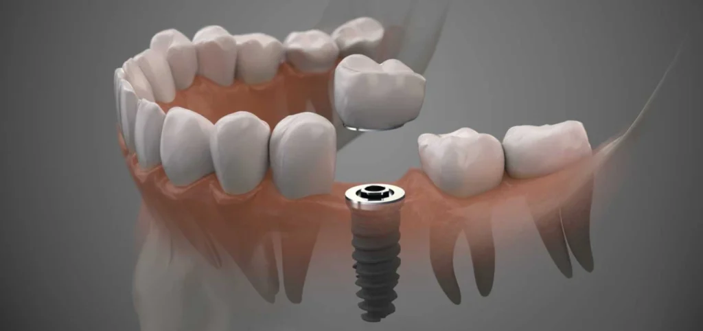 Implant unitaire dentiste Toulouse 31000